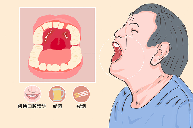 杭州御和堂老中医为你讲解：口腔癌应警惕四种症状。
