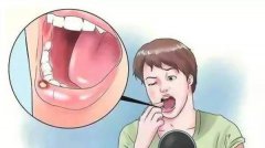 杭州御和堂老中医传授治疗口腔溃疡10种方法