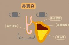 鼻窦炎的致病因素有哪些?杭州御和堂老中医在线解答