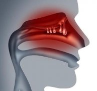 鼻息肉的症状表现有哪些?