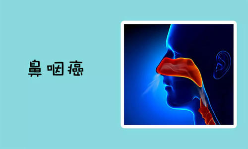 鼻咽癌的症状有哪些?