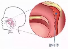 看杭州御和堂老中医如何解读腺样体的症状！